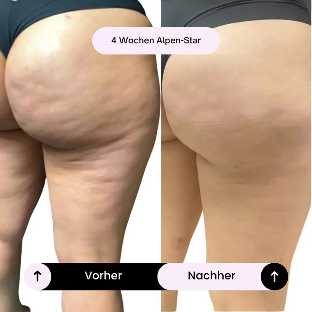 Alpen-Star Cellulite-Massagegerät™